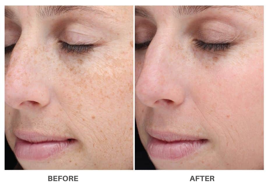 Laser Skin Resurfacing For Younger Healthier Skin