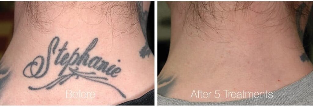 tattoo removal cost estimate